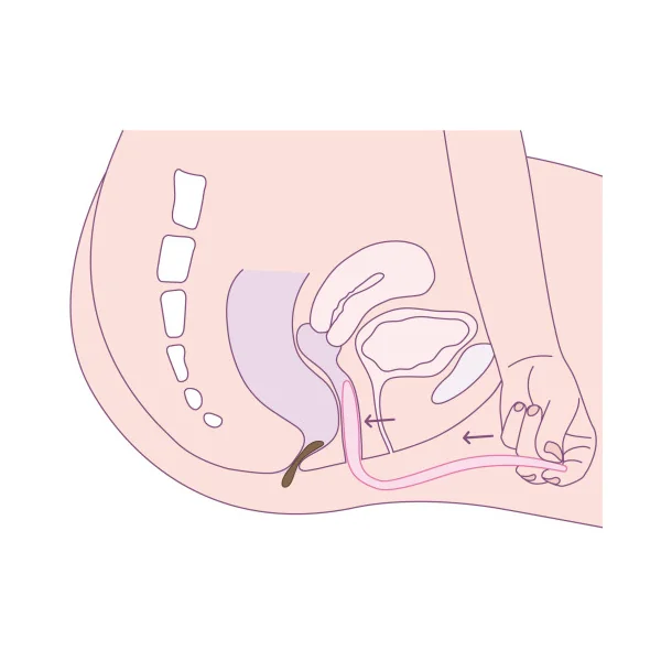 Dispositif pour rectocèle Femmeze