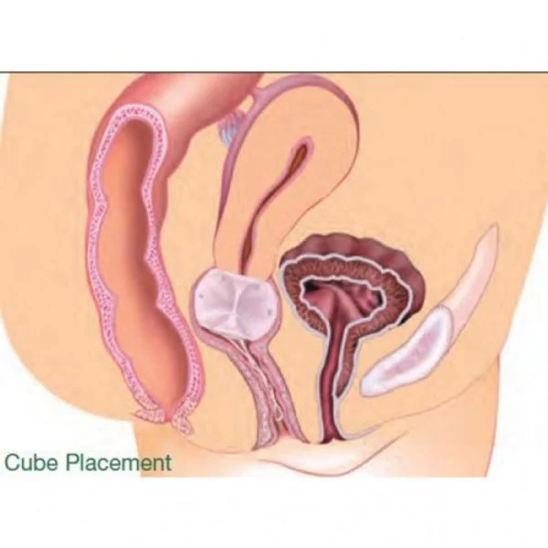 GYNEAS Pessaire Gyn et Cubic Ø55mm Taille 7 - Prolapsus Utérin Stade 3, Cystocèle, Rectocèle