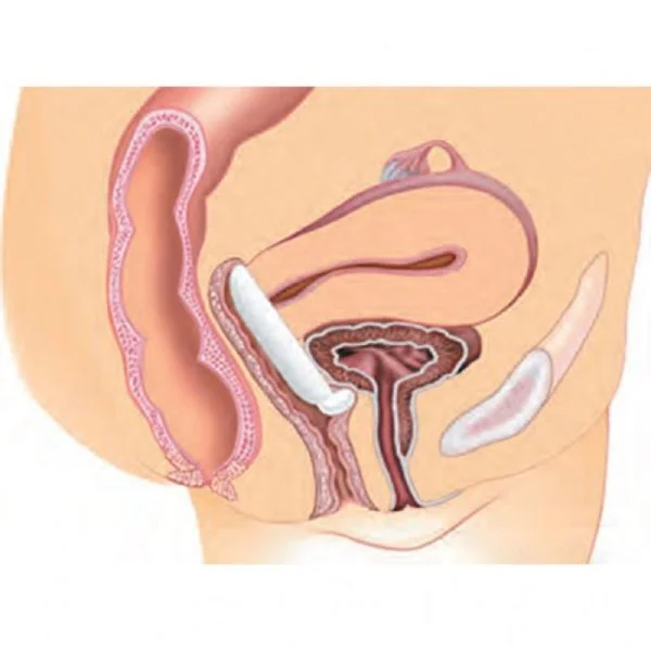GYNEAS Pessaire Gyn et Dish Ø60mm Taille 2 - Prolapsus Utérin Stade 1 et 2, Cystocèle, Incontinence