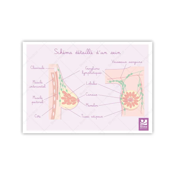 Illustration Les différents stades du cancer du sein et schémas détaillés du sein