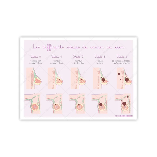 Illustration Les différents stades du cancer du sein et schémas détaillés du sein