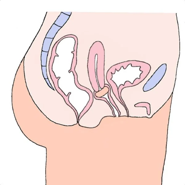 MILEX Pessaire DONUT Ø57mm Taille 1 - Prolapsus Génital Stade 3 et 4, Incontinence