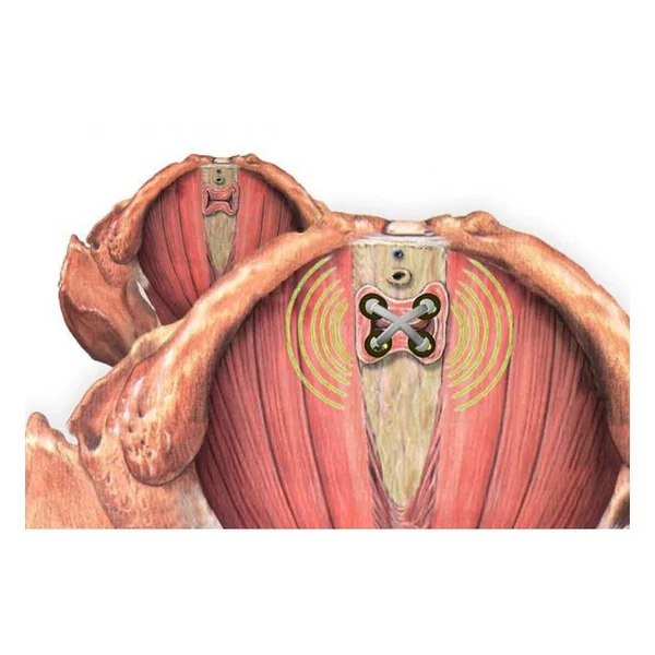 Sonde vaginale PERISPHERA H